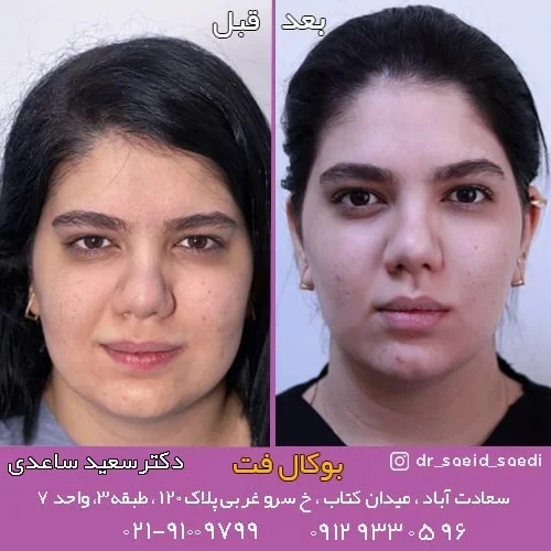 بوکال فت صورت چیست