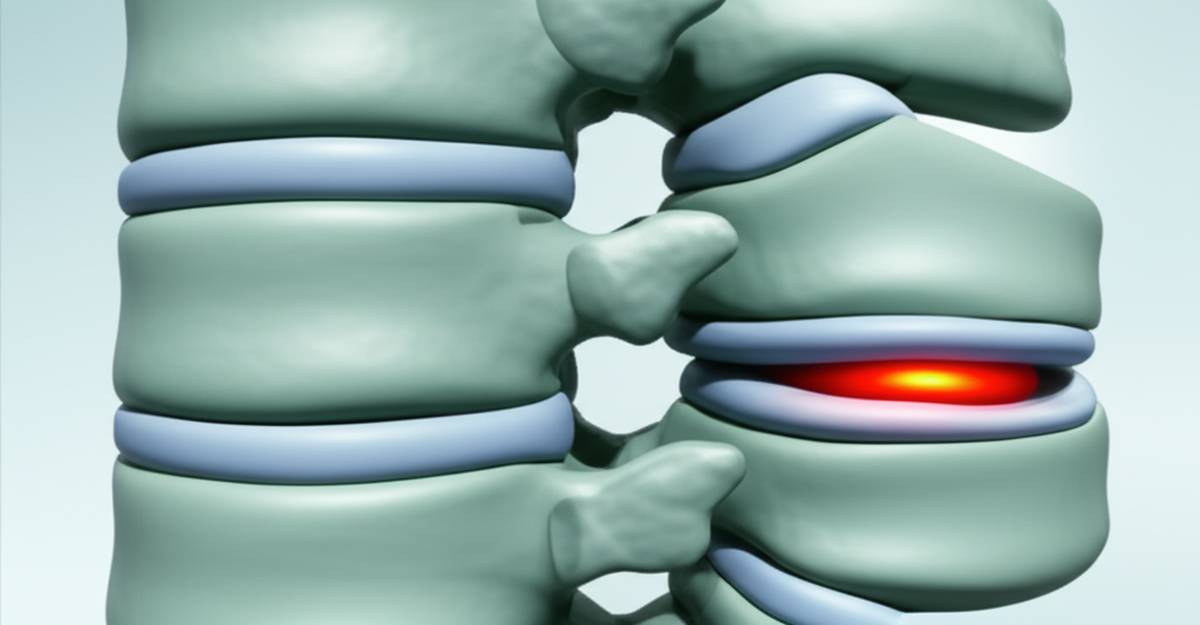 تفاوت دیسک کمر و فتق دیسک چیست؟ راهنمای تشخیص در خانه