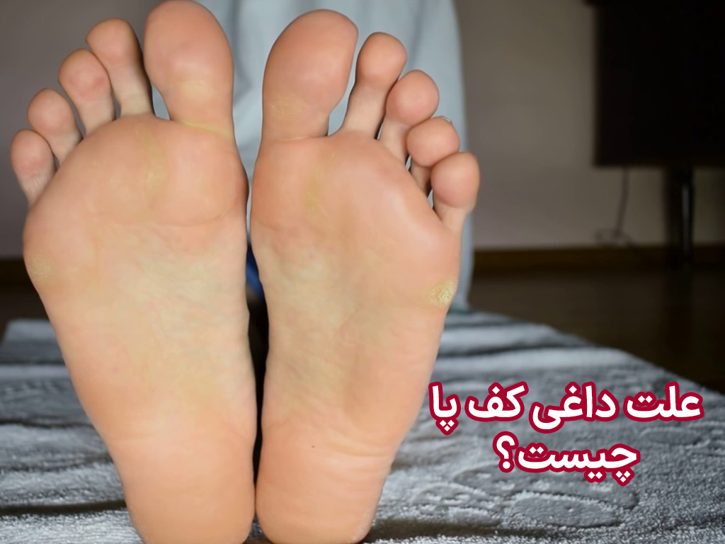 علت داغی کف پا چیست؟